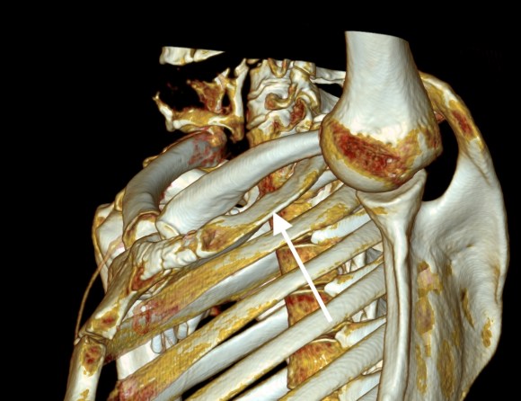 CTV CEST 1.0 MPR sag