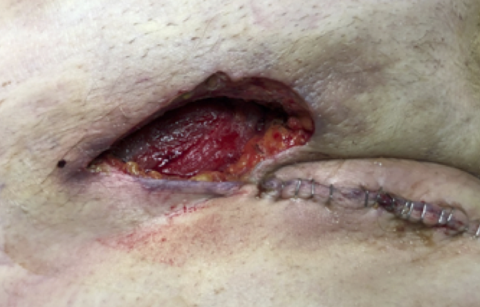 wound virvilis flap.png