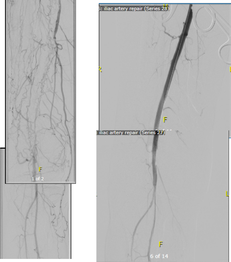 before and after endoRE