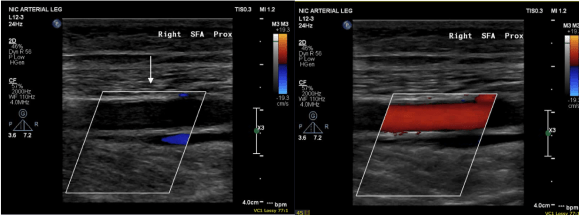 postop duplex at 2 months