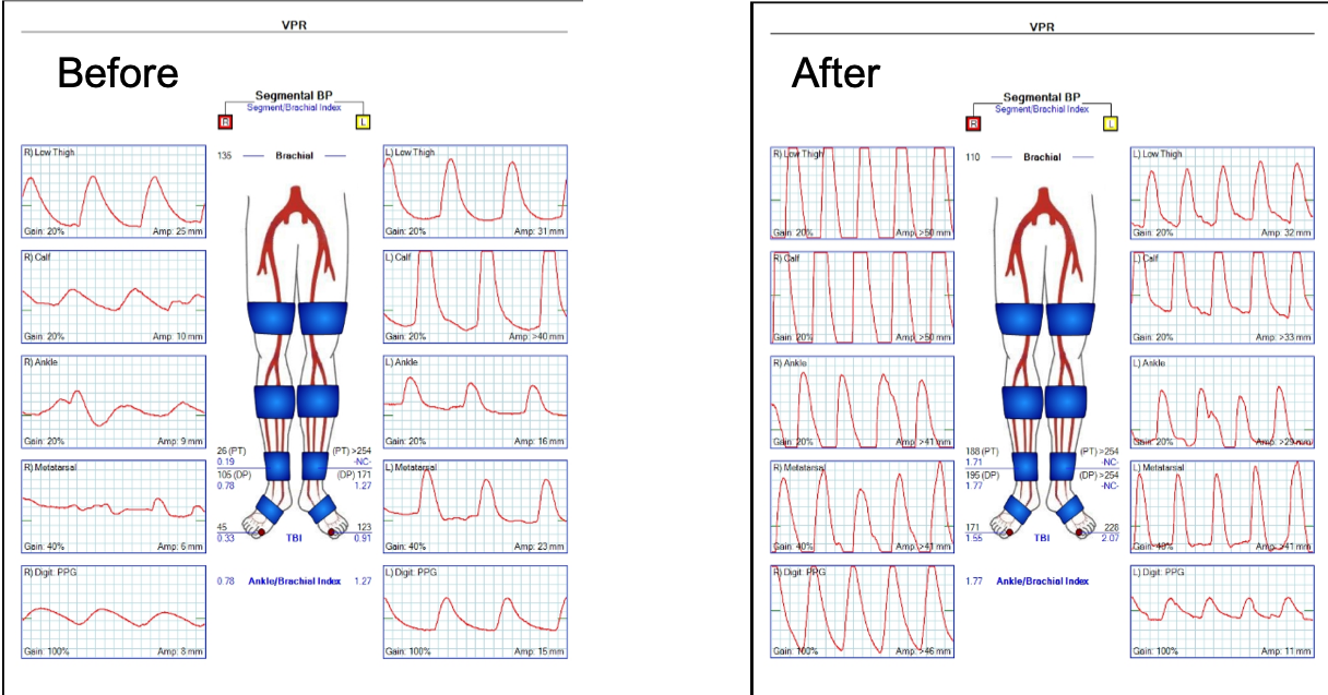 PVR before and after