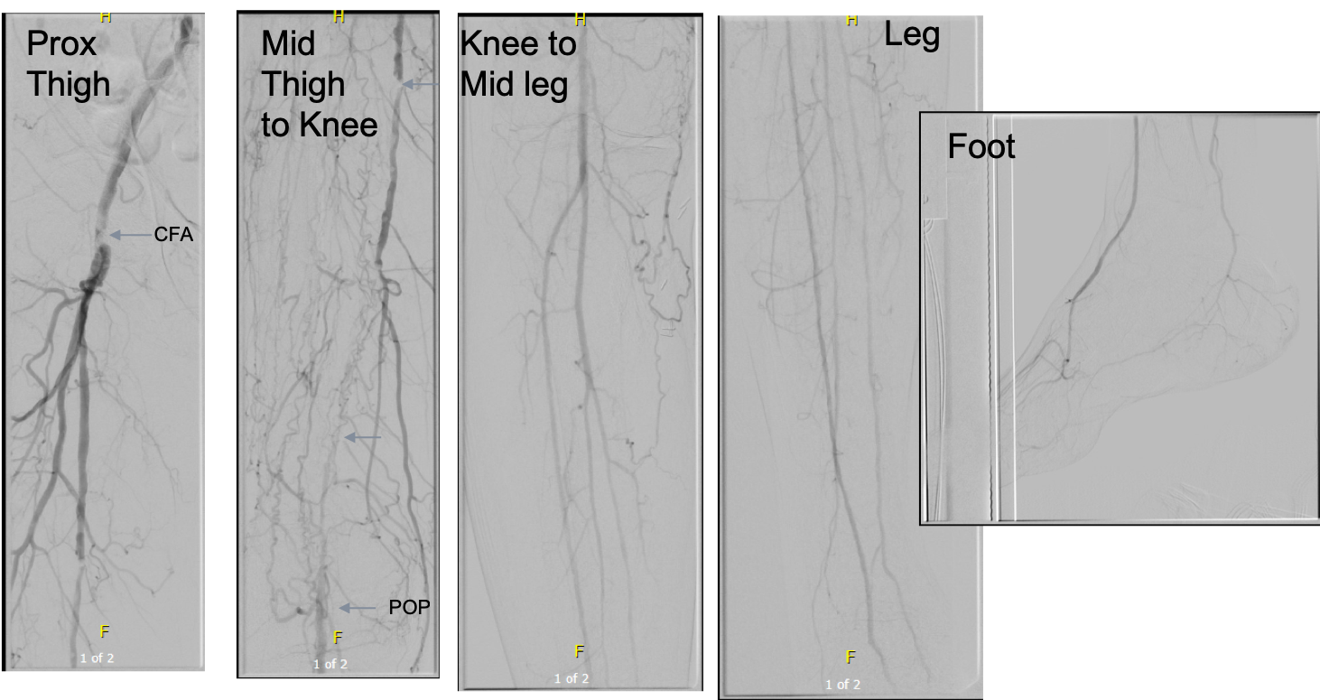 R SFA arteriogram