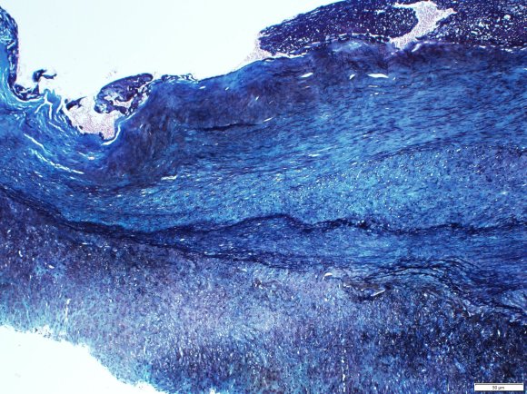 04-SP-19-4119 Trichorme stain showing fibrous tissue as green