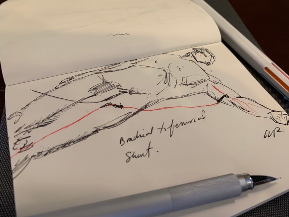 brachial to femoral shunt sketch