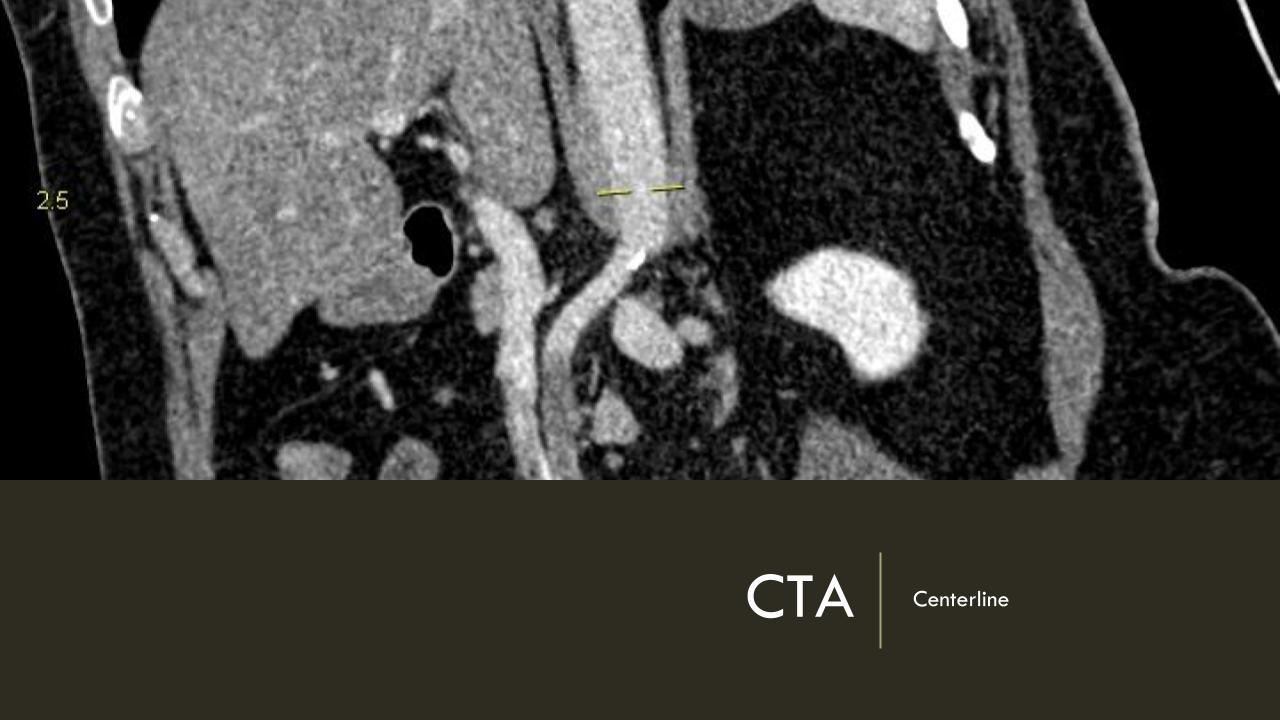 Acute Mesenteric Ischemia case presentation (1)