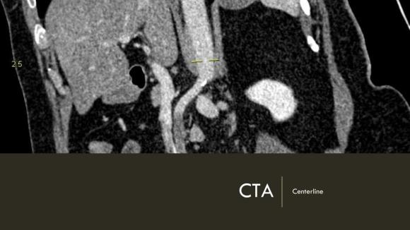 Acute Mesenteric Ischemia case presentation (1)