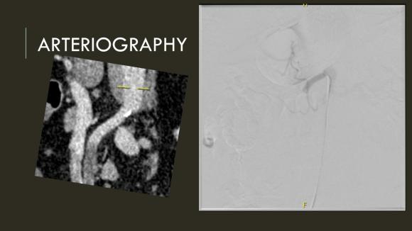 Acute Mesenteric Ischemia case presentation (2)