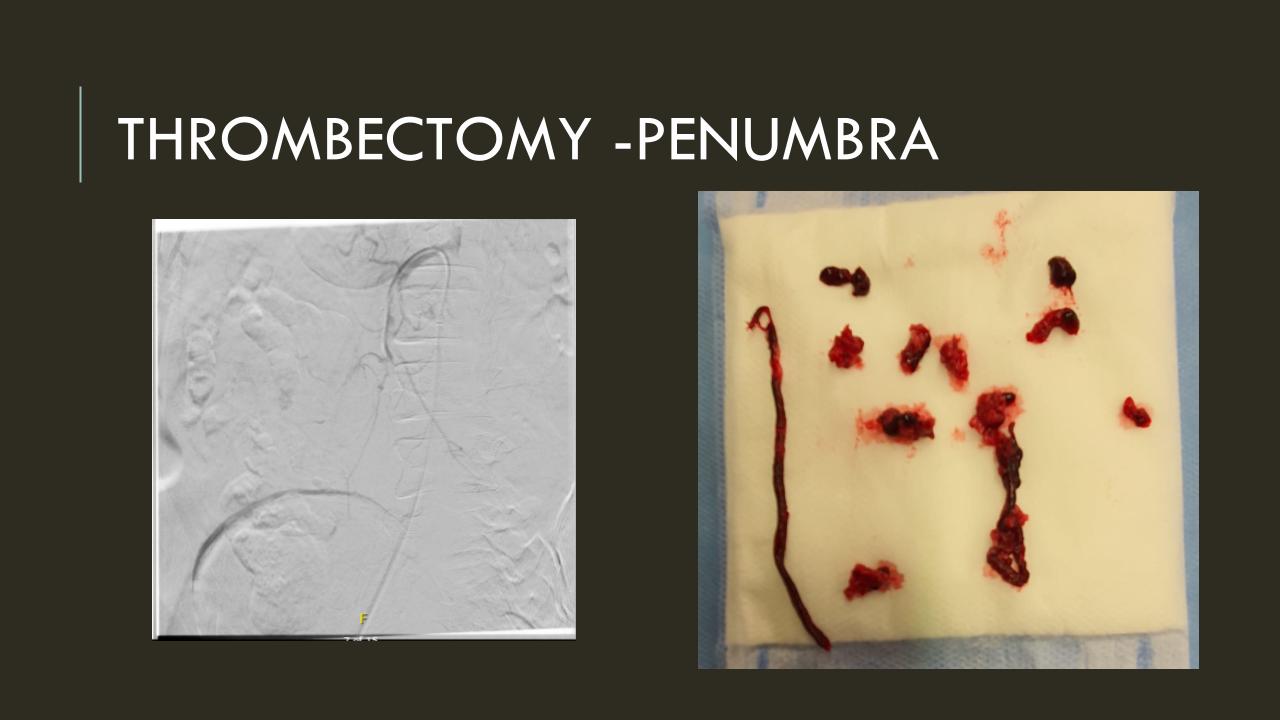 Acute Mesenteric Ischemia case presentation (3)