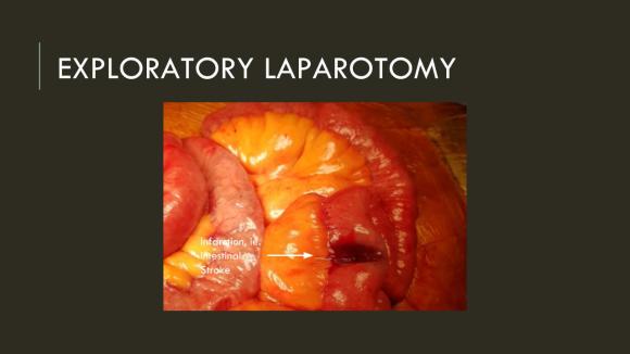 Acute Mesenteric Ischemia case presentation (6)