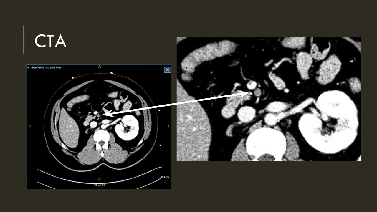 Acute Mesenteric Ischemia case presentation