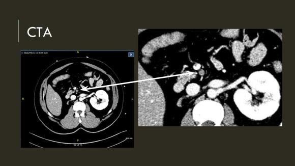 Acute Mesenteric Ischemia case presentation