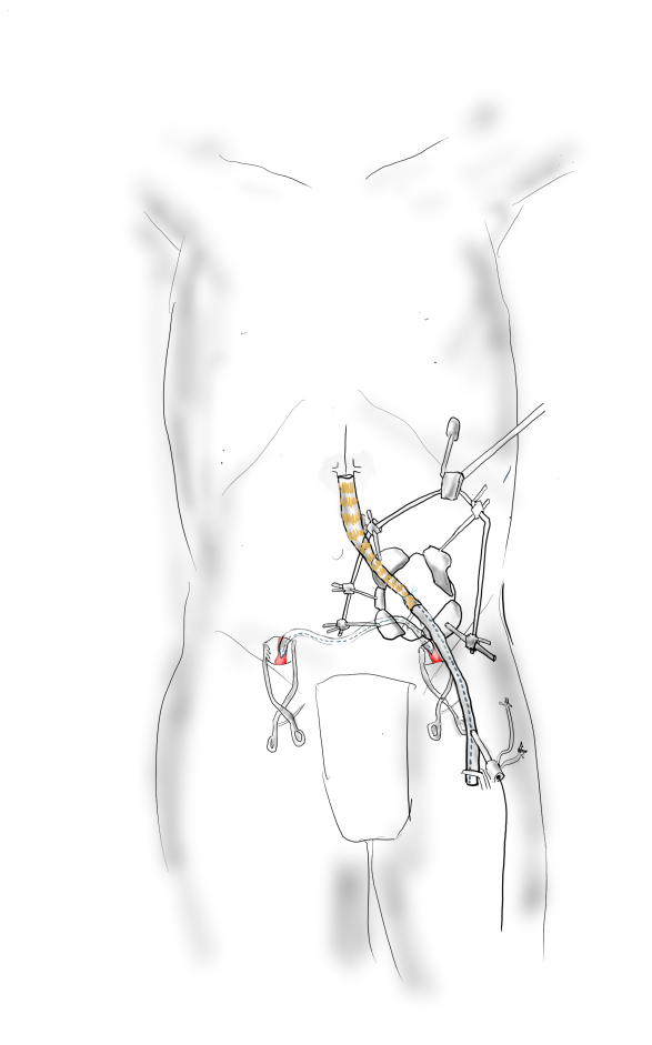 aortoiliac occlusive disease (AIOD) – A Surgeon's Notes