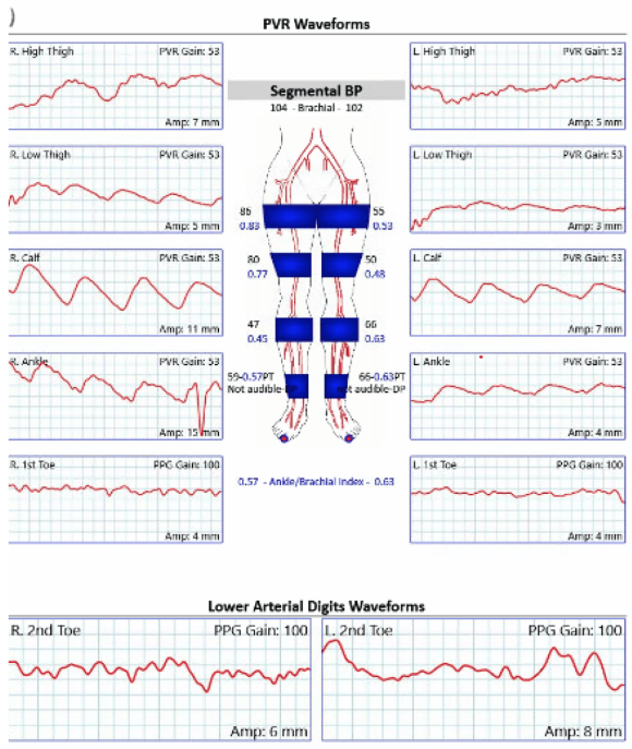 aortoiliac occlusive disease (AIOD) – A Surgeon's Notes